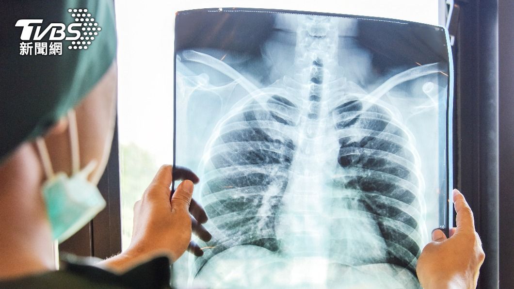 沒想去年底檢查出罹患肺腺癌且在日前不幸病逝。（示意圖／shutterstock 達志影像）