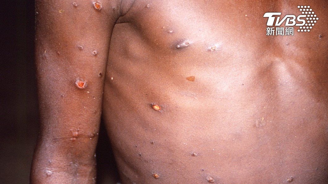 猴痘蔓延 世衛：恐對全球公衛構成中度風險