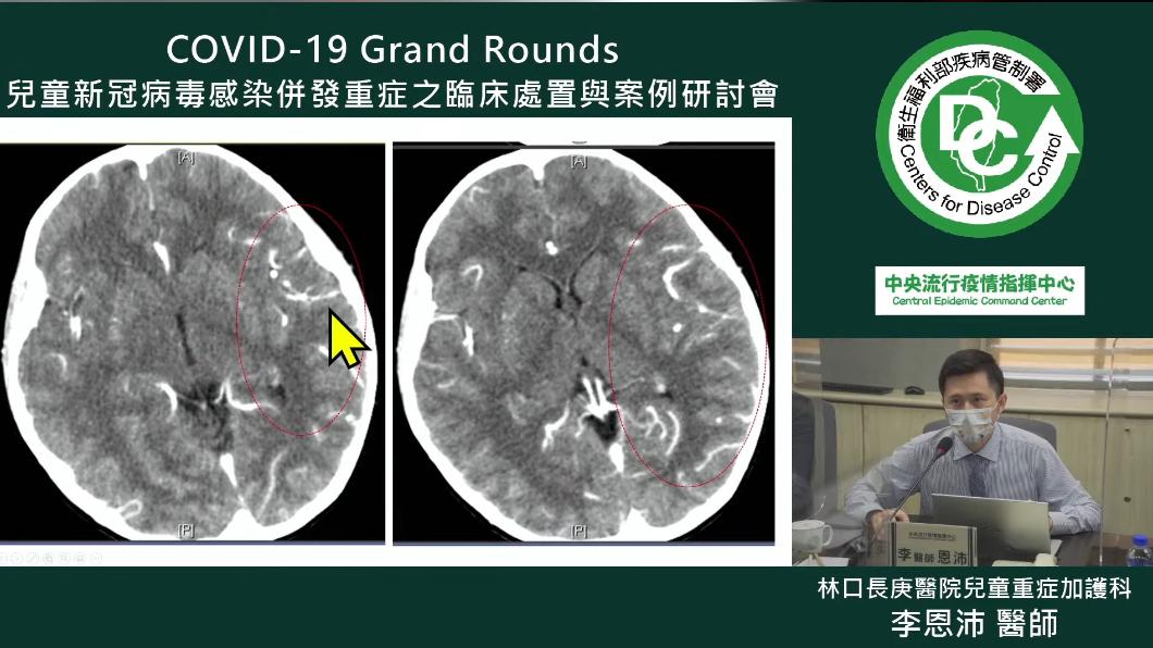 男童有腦炎症狀。(圖/翻攝自疾管署YouTube)