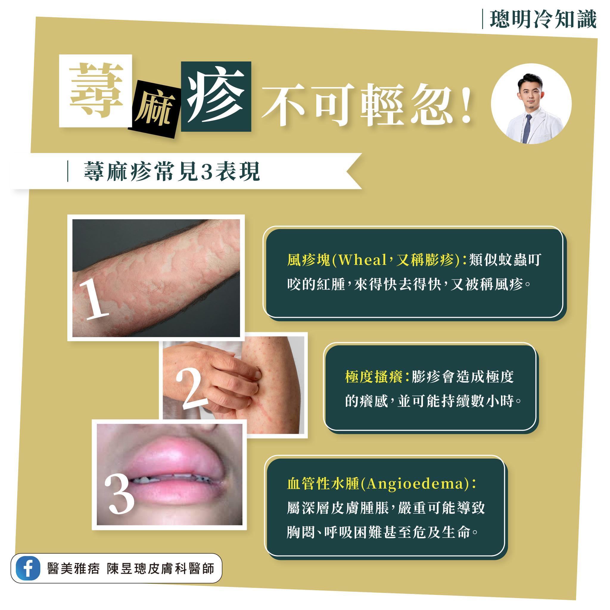 蕁麻疹常見症狀。（圖／翻攝自陳昱璁醫師臉書）