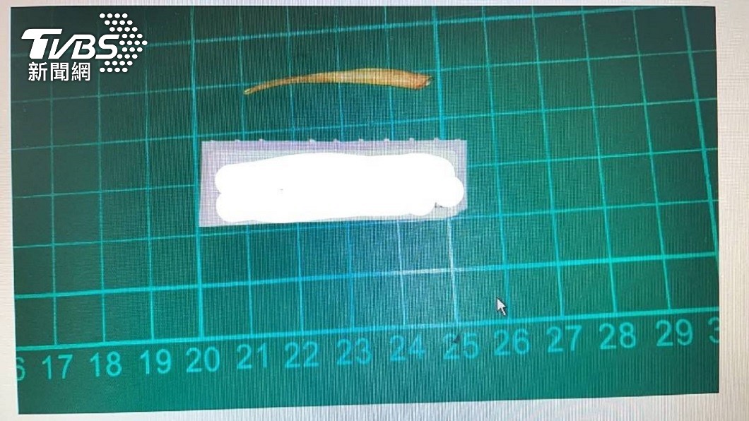 4公分魚刺穿破直腸卡肛門 女開刀撿回一命得終生洗腎