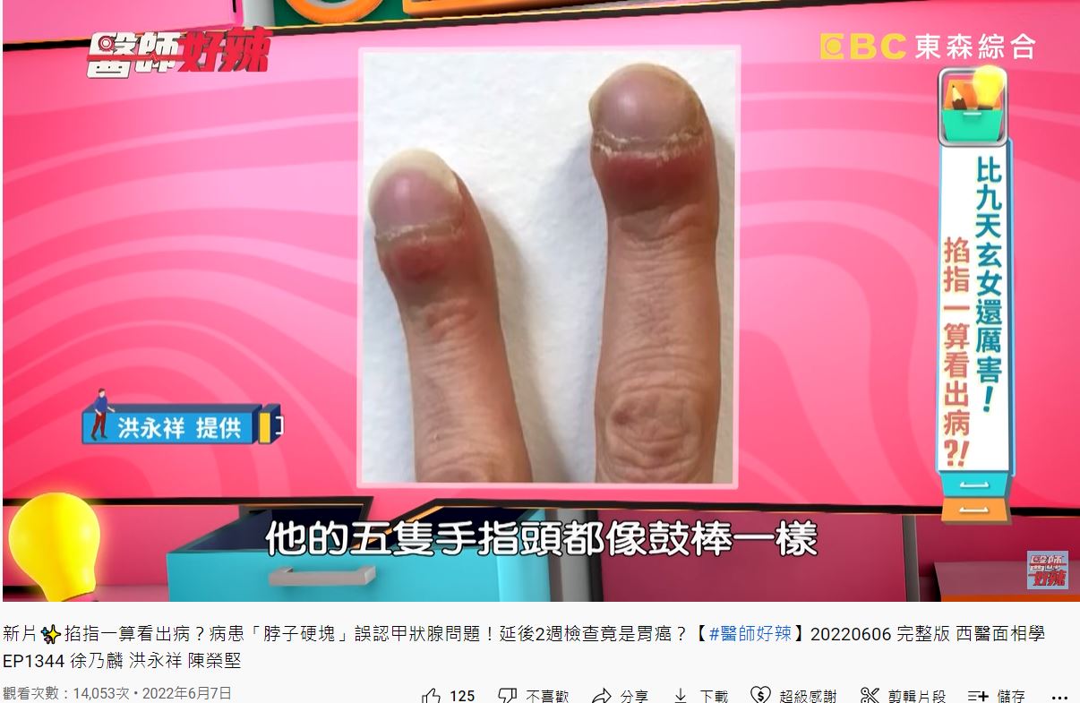 婦人手指頭腫得像鼓棒。(圖/翻攝自《醫師好辣》YouTube)