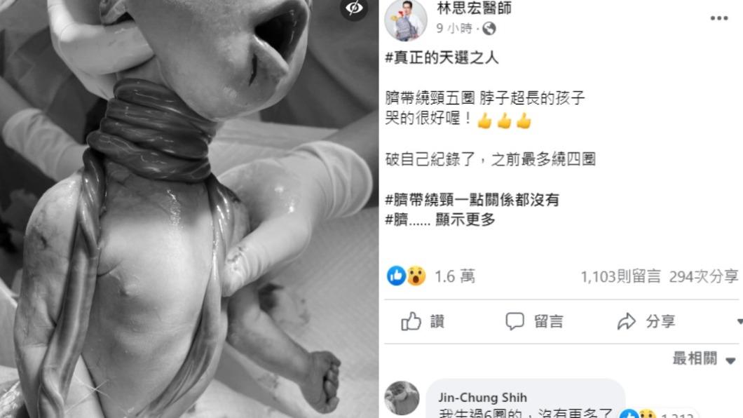 臍帶繞頸5圈照令人震撼,貼文讓台大仁醫施景中也忍不住在留言區分享經驗。(圖/翻攝自林思宏醫師臉書)