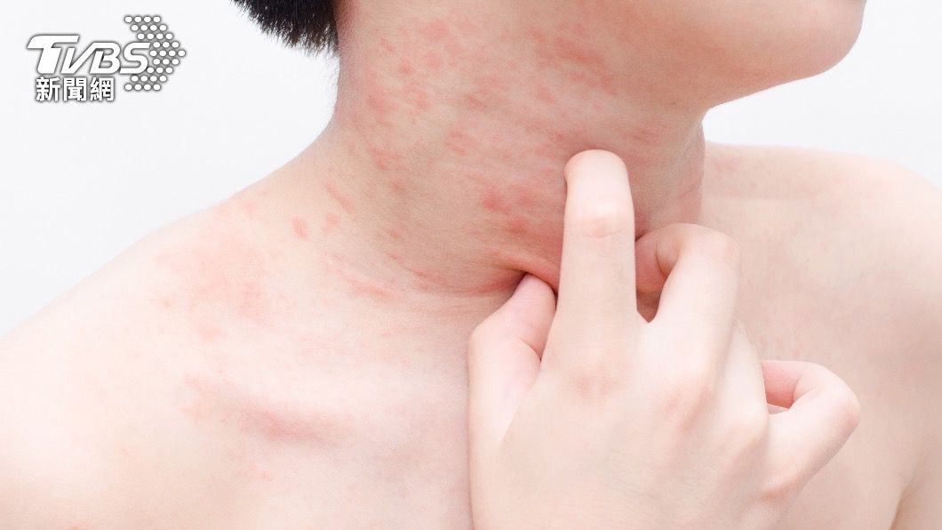 MIS-C症狀會合併皮疹。(示意圖/shutterstock達志影像)
