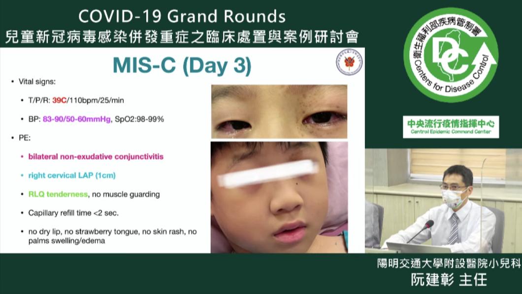 男童罹患MIS-C後,出現雙眼紅的情況。(圖/衛生福利部疾病管制署Youtube)