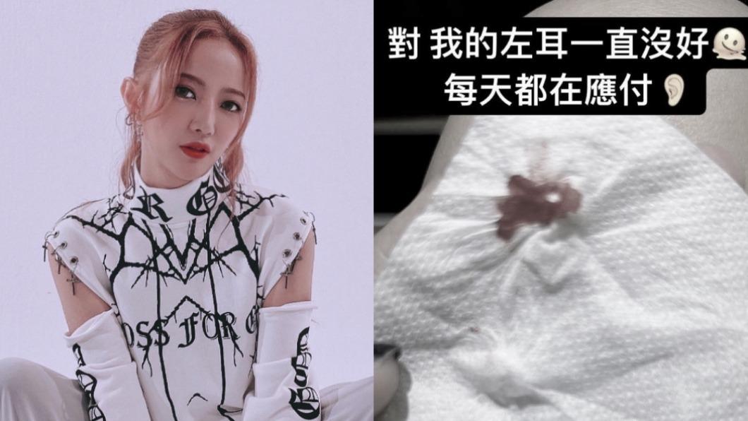 女星左耳聽力剩2成 「反覆流血流膿」最新病況曝