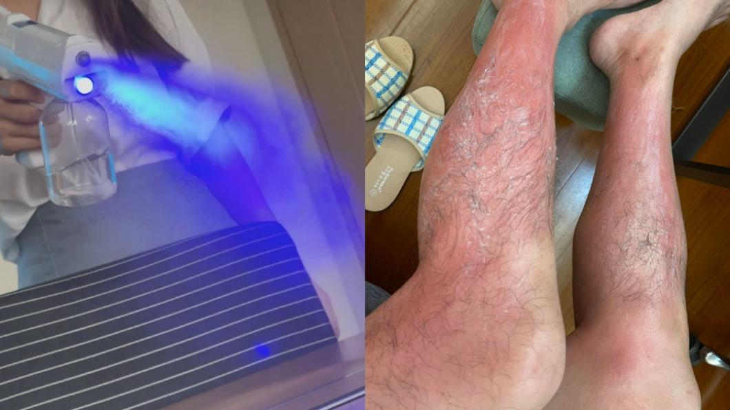 紫外線燈殺菌有風險!他雙腿燙傷「眼睛睜不開」 恐怖後果曝