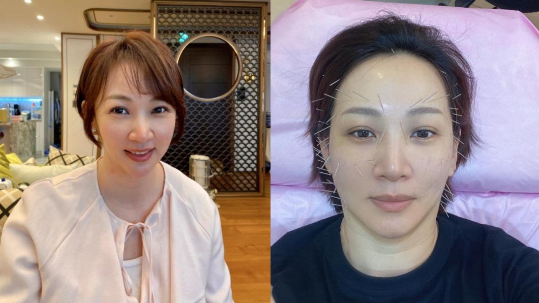臉上狂扎70多針!郁方變「仙人掌」網嚇:看了頭皮發麻