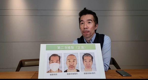 張兆志植髮過程,後腦勺頭皮都是血洞。(圖/翻攝自張兆志臉書)