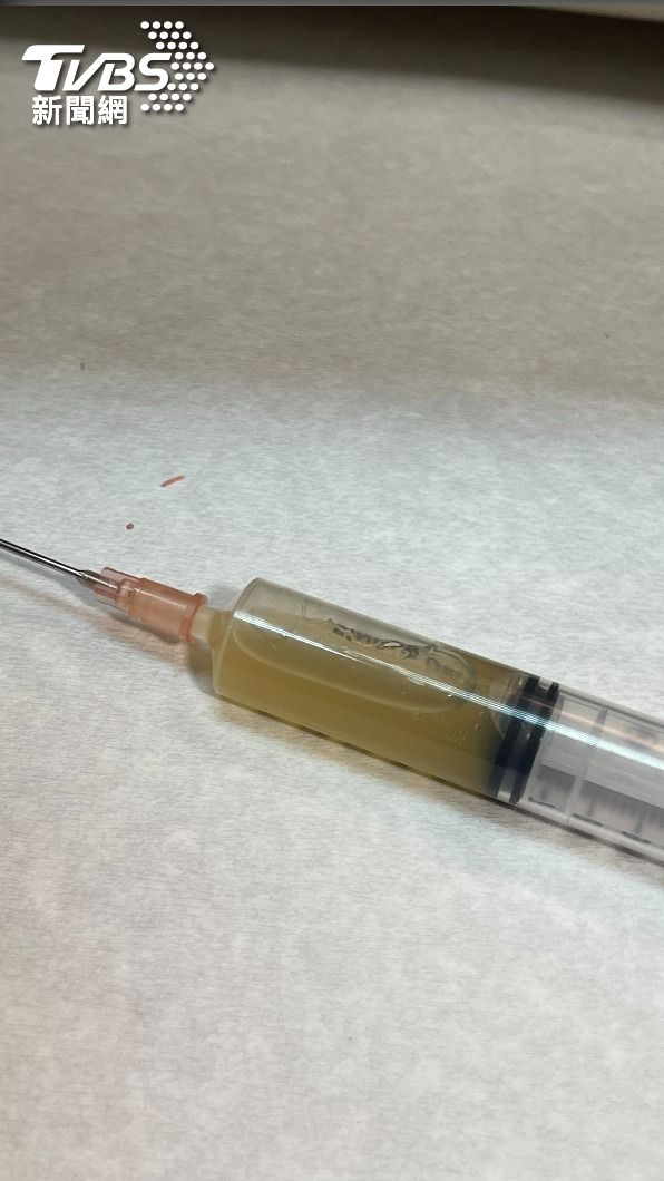 巴氏腺囊腫可經由抽吸分泌物與服藥後得以緩解。(圖/院方提供)