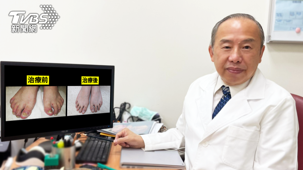 乾癬性關節炎是長期疾病,需要長期抗戰、學習共存。(圖/院方提供)