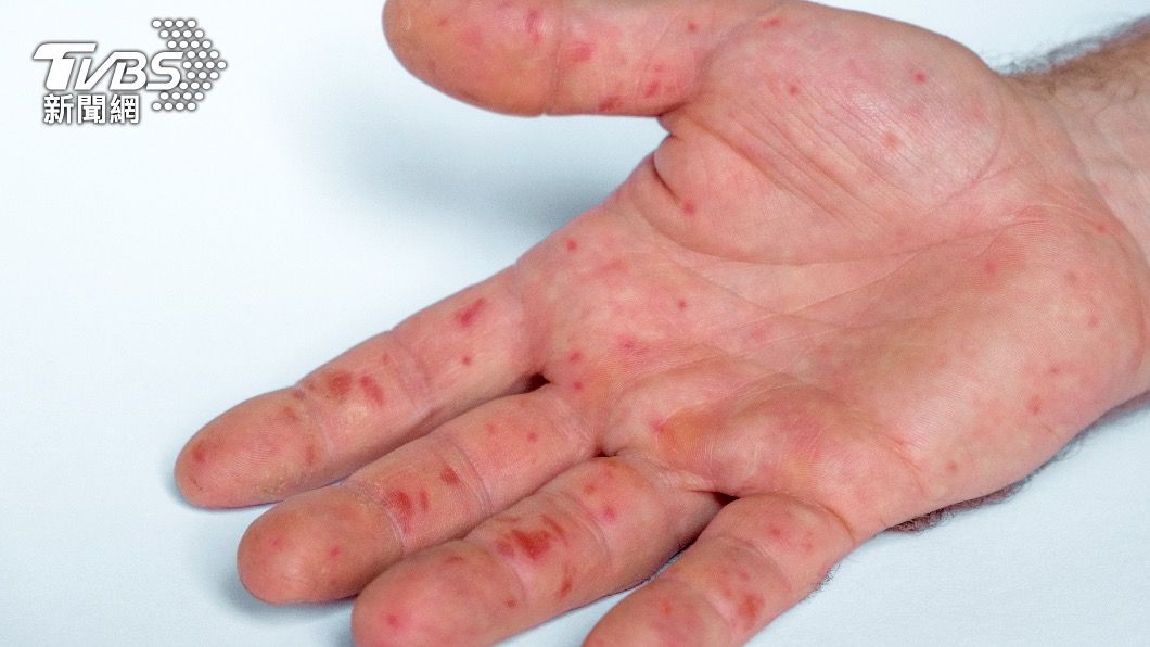 恐有漏診之虞 研究:英國猴痘患者症狀有別以往