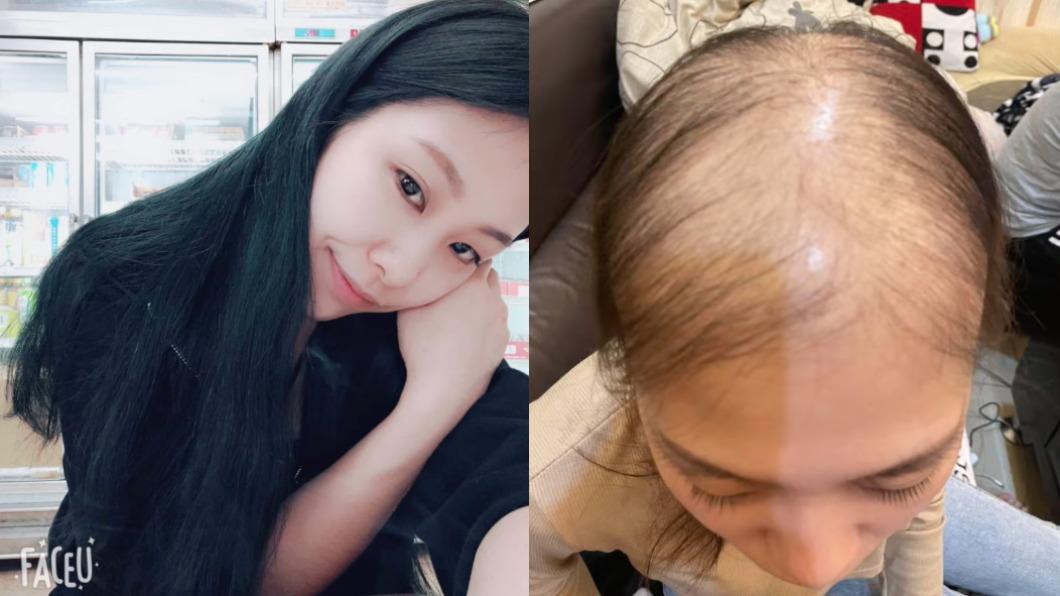 長髮全掉!打疫苗1個半月變光頭 正妹喊:至少我還活著