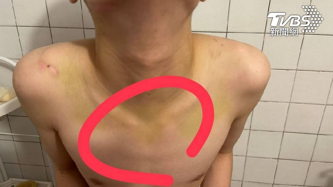重捶還是輕敲?物理治療師的一拳 病患家屬和醫院吵沒完