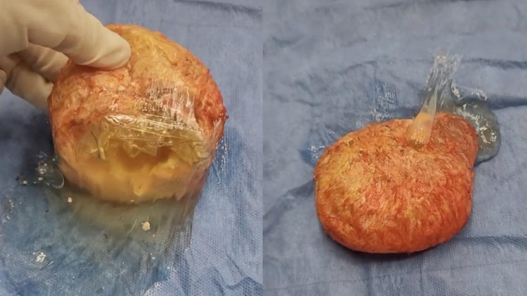 從阿嬤體內取出的矽膠已經鈣化破裂，流出黃色史萊姆。（圖／翻攝自withdrnicole TikTok）