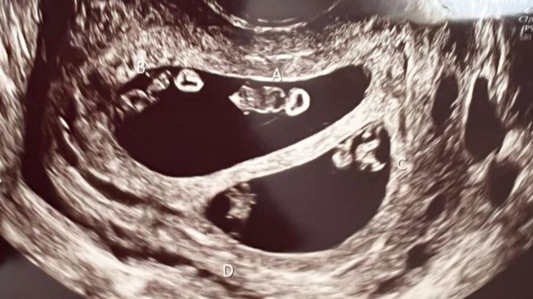 一次來4個!女懷「2對雙胞胎」嚇傻:僅千萬分之1機率