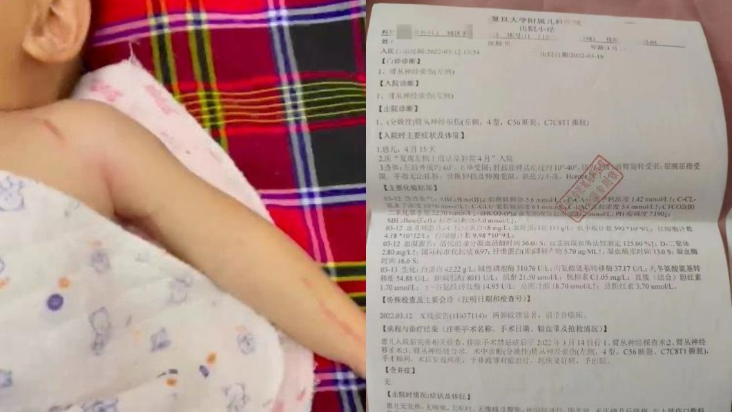 接生扯斷寶寶手臂 醫「只願賠30萬」:不拉斷就出不來