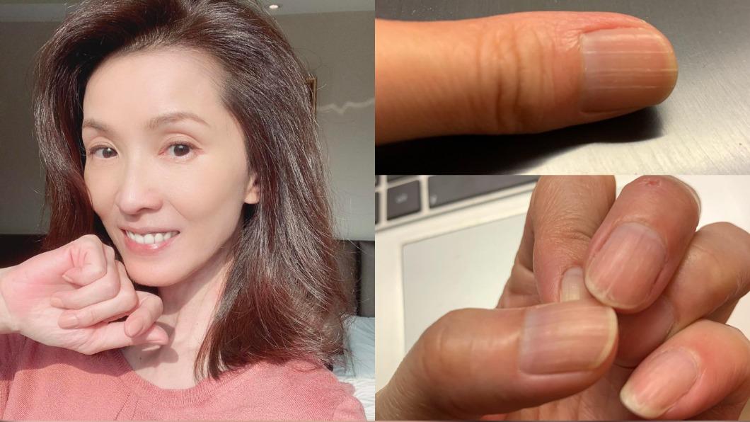 葉全真於5月確診，隔離期滿後，發現指甲上出現粗糙條紋。（圖／翻攝自葉全真 Elsie Yeh臉書）