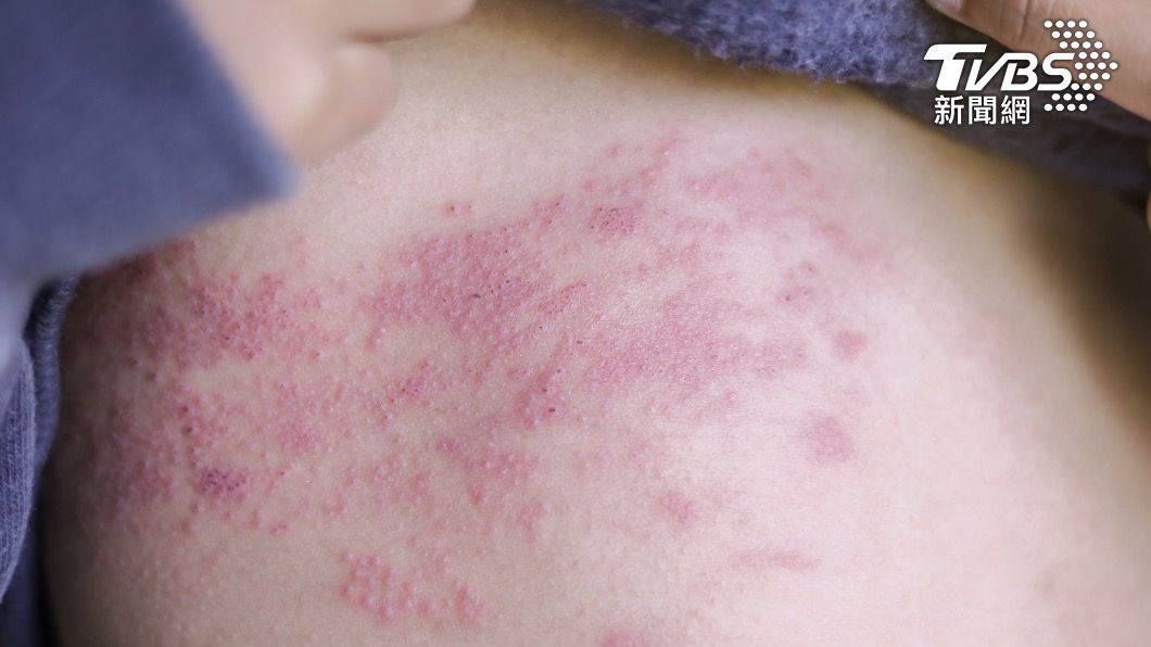 帶狀皰疹又俗稱「皮蛇」。(示意圖/shutterstock達志影像)