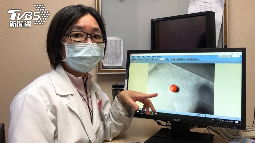 女搬家撞傷手！瘀青消後竟「長出腫瘤」　一碰就痛急就醫