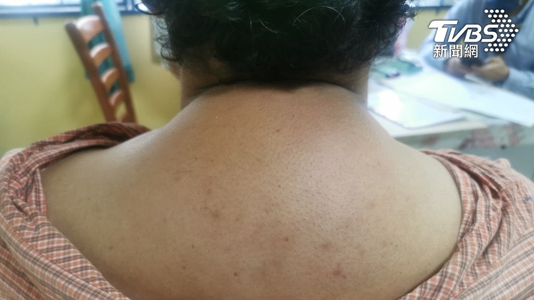 後頸凸一塊怎回事?低頭族小心「富貴包」 中醫3法改善