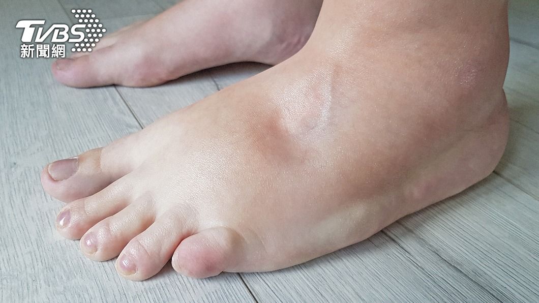 又水腫了嗎？盤點「6種鈉含量超標食物」　小心吃過量