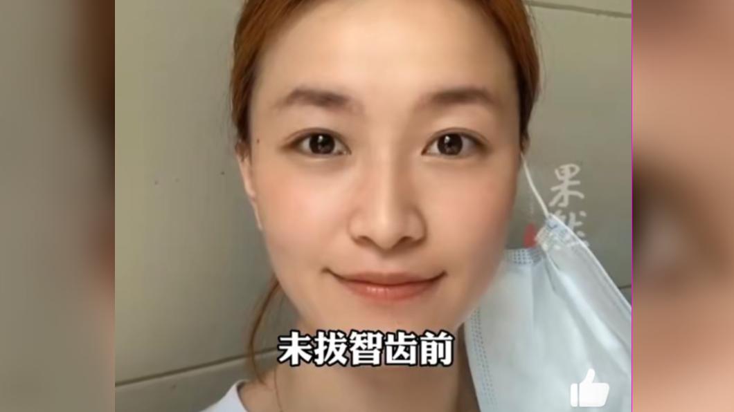 該女子未拔智齒前模樣曝光。(圖/翻攝自微博)