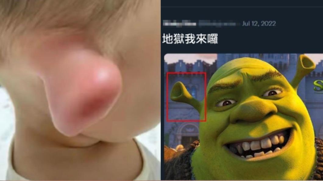 嚇壞家長!小孩被叮「耳朵腫成史瑞克」 驚悚畫面惹心疼