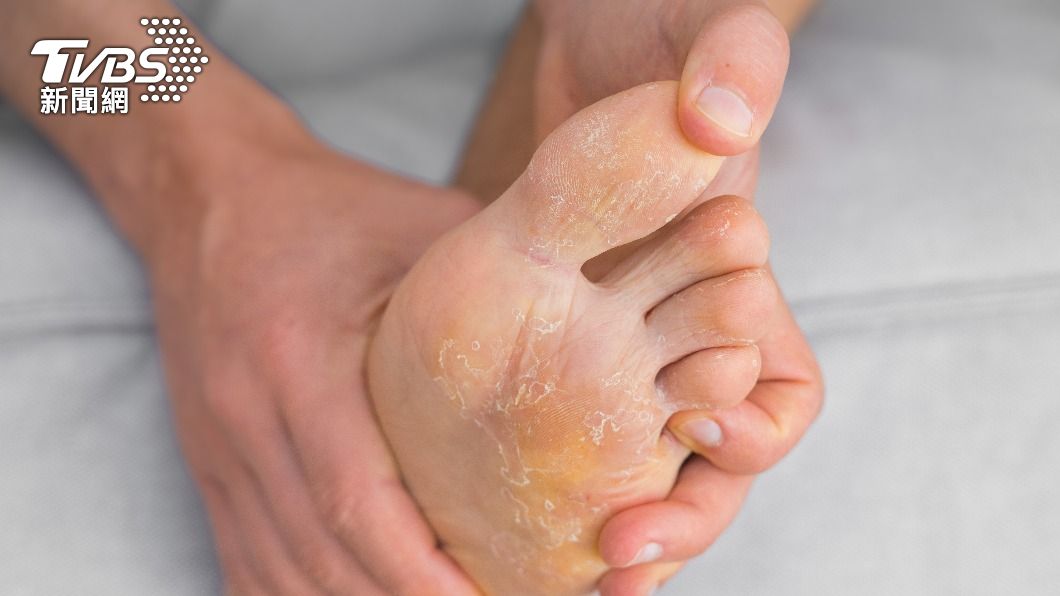 腳掌及側邊會出現整片或局部脫皮。(示意圖/shutterstock達志影像)