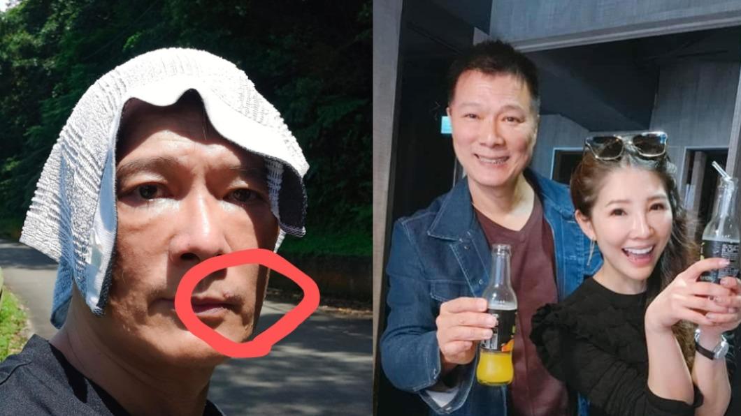 面部被病毒攻擊!蔡詩萍「右臉刺麻」 嚴重恐視神經受損