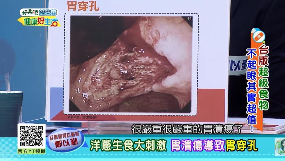 患者生吃蔥薑蒜導致胃穿孔。(圖/翻攝自年代MUCH台 健康好生活YouYube)