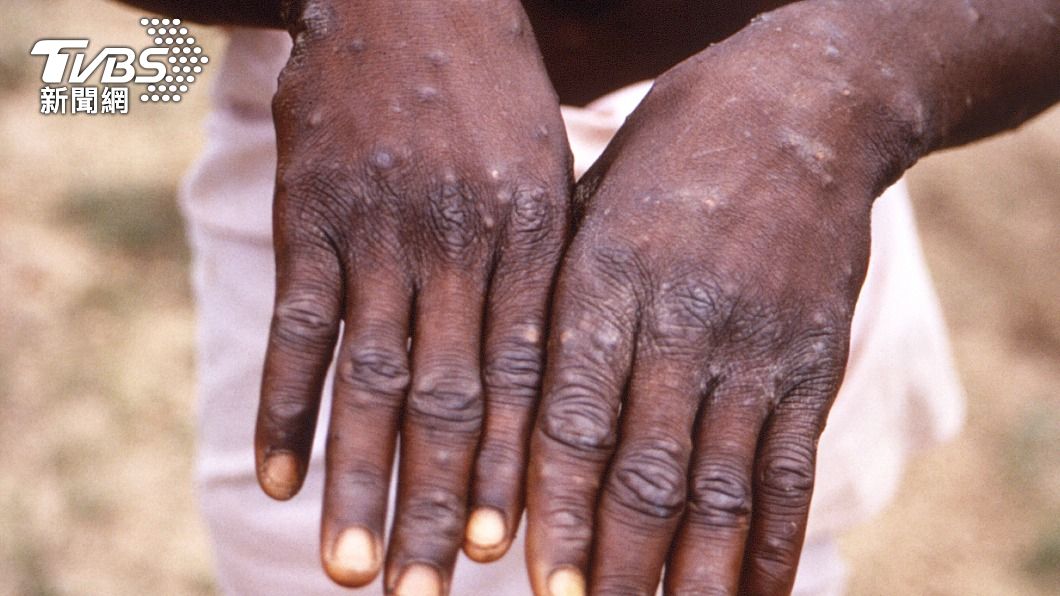美破千人染猴痘 佛奇、前食藥局長示警:確診數恐低估