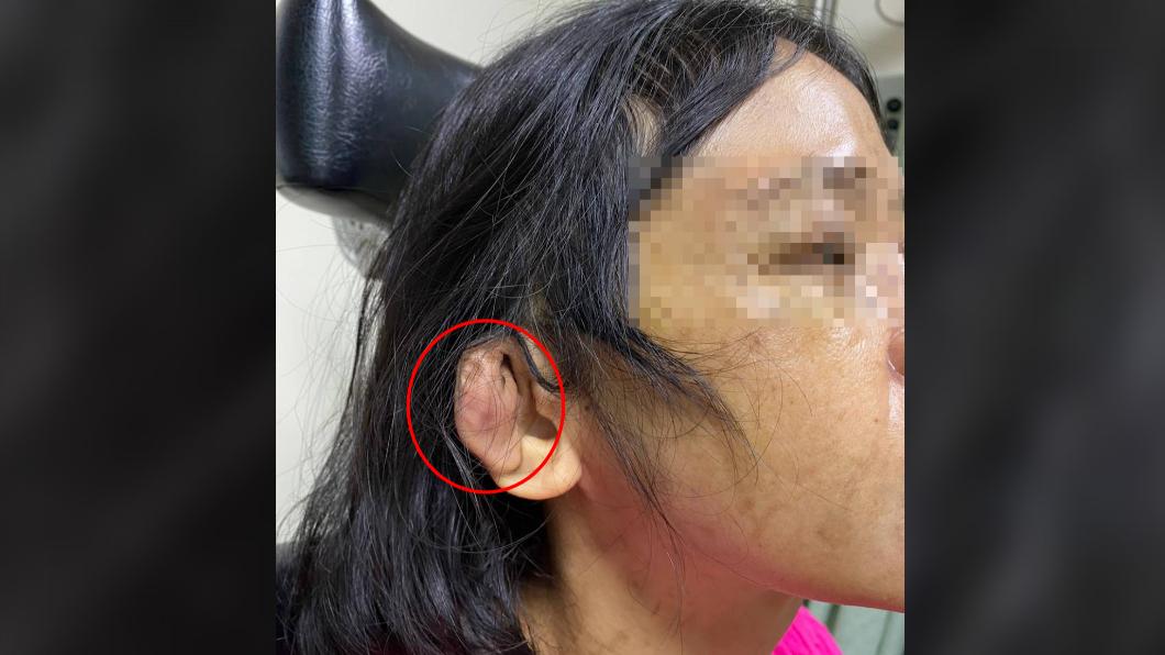 耳朵遭毆打後腫脹。（圖／翻攝自爆料公社）