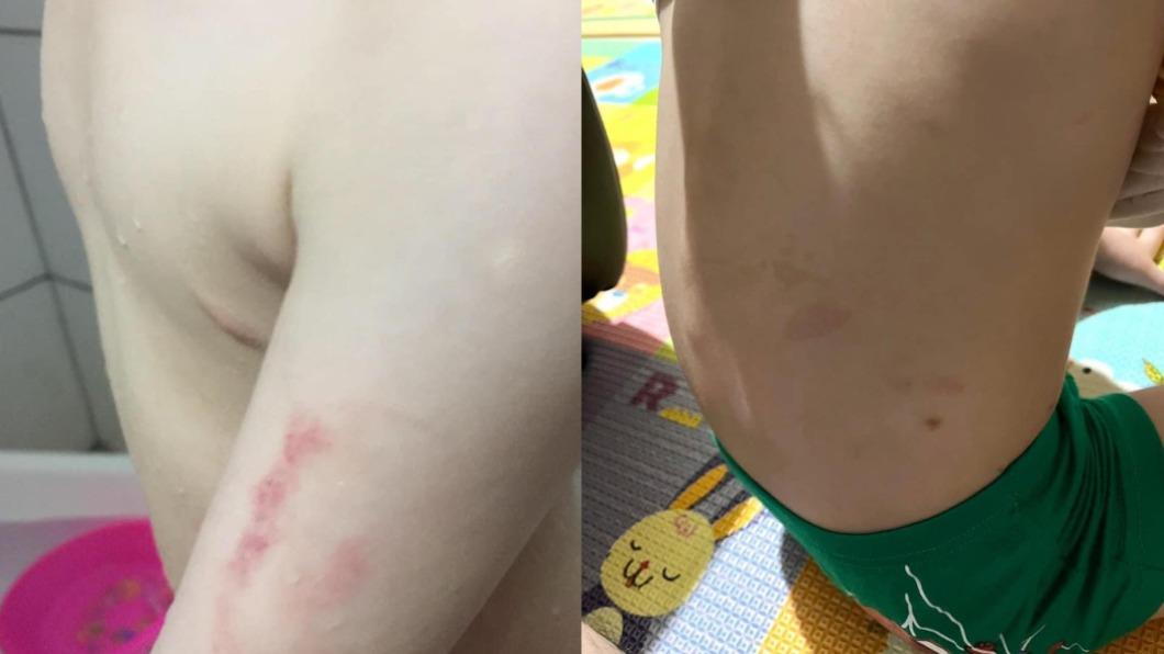 男童身上有多處瘀傷。(圖/翻攝自臉書)