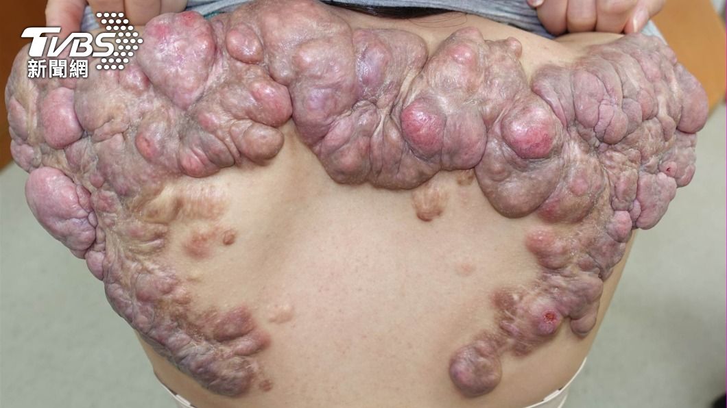 妙齡女抓破痘痘!15年長出「巨蟲」 半公斤蟹足腫爬滿背