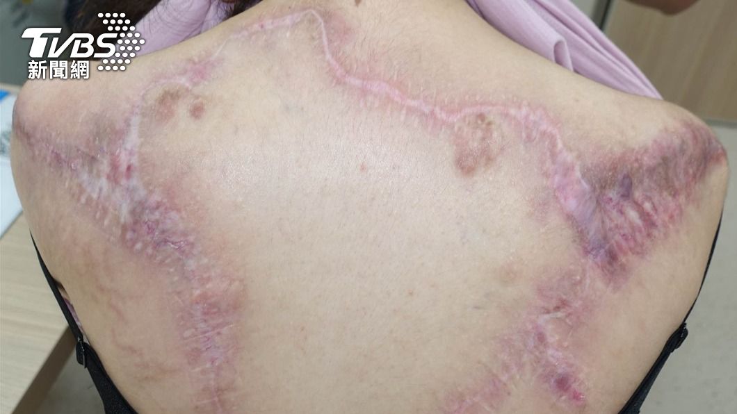 患者經手術切除蟹足腫後,門診追蹤2年至今未再復發。(圖/長庚提供)