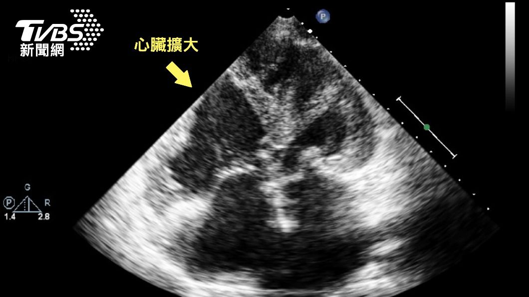 患者在術前心臟右側擴大。(圖/院方提供)