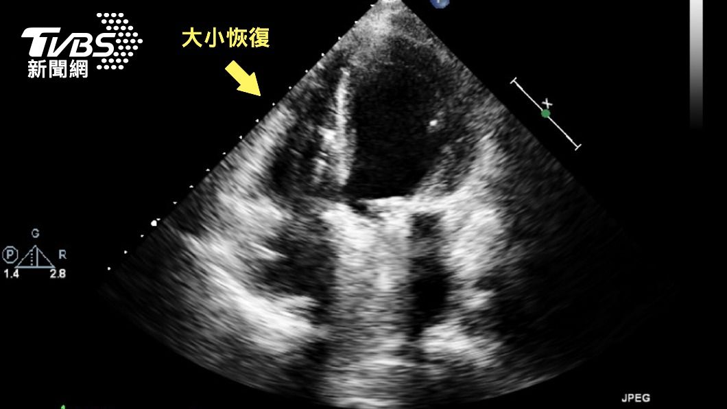 患者術後心臟右側大小恢復。(圖/院方提供)