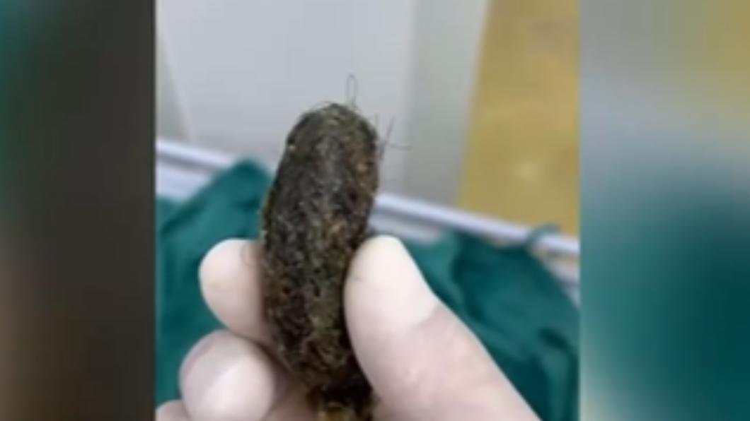 女童腹痛發燒!醫見胃裡卡「一坨頭髮」 竟用這飲料救命