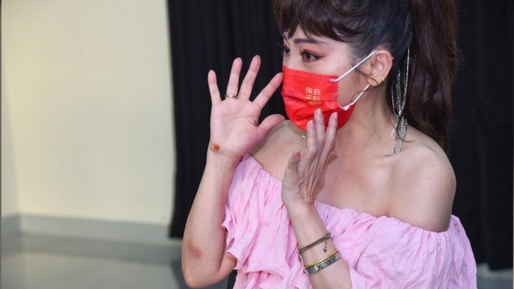 王彩樺現身時手臂大片瘀青,右手大拇指瘀青嚴重。(圖/高雄流行音樂中心提供)