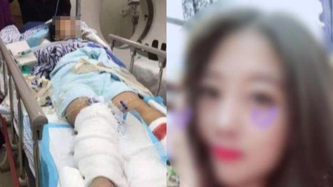 正妹出車禍腿被截肢 厚臉皮肇事男:嫁我就付醫藥費