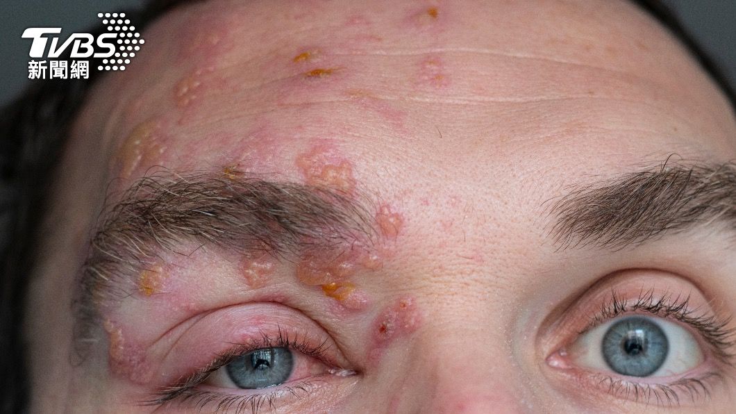 比生產還痛!每3人有1人罹「皮蛇」 恐影響視力、聽覺