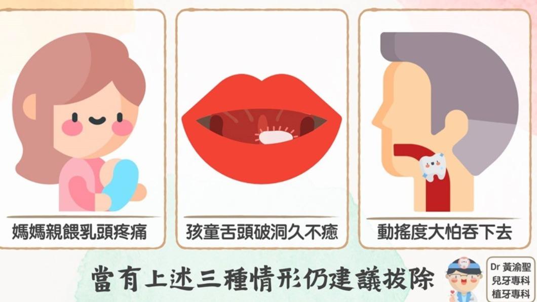 醫生點出3狀況需提早拔牙。(圖/黃渝聖醫師提供)