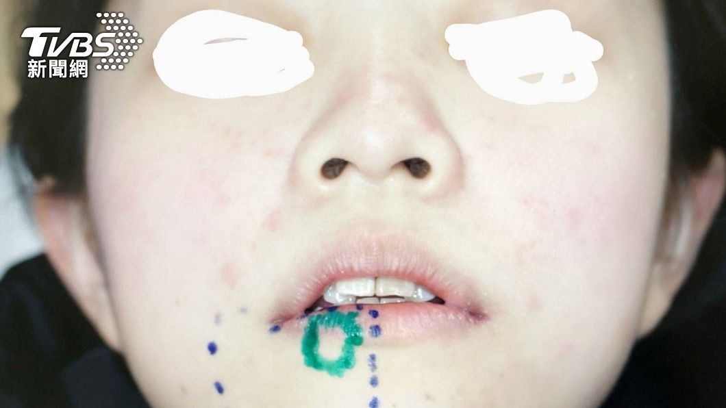 正妹下巴突麻痺 竟是罕見智齒長歪壓神經