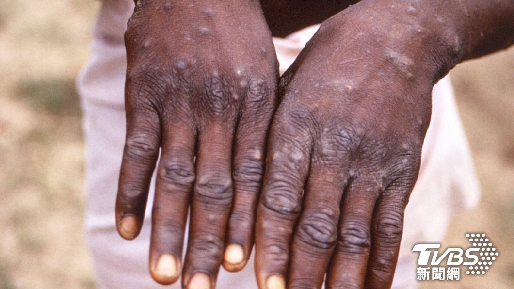 「猴痘」病毒引發恐懼 巴西人類攻擊猴群案件大增