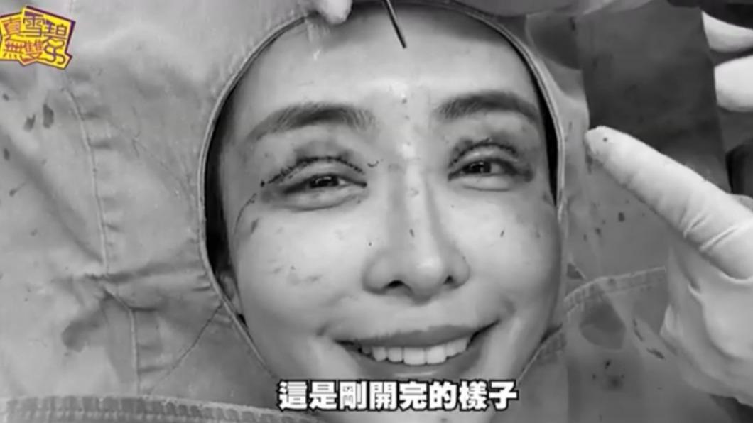 雪碧公開割雙眼皮的過程。(圖/翻攝自雪碧YouTube)