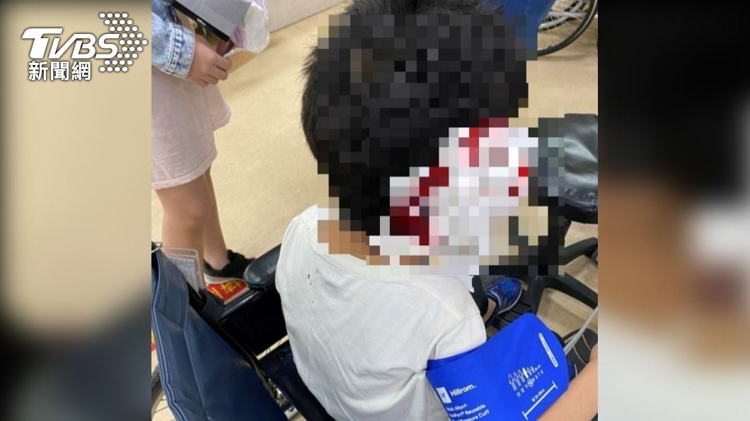 7歲童玩耍不慎撞樓梯「頭破血流」 父急攔巡邏車開道送醫