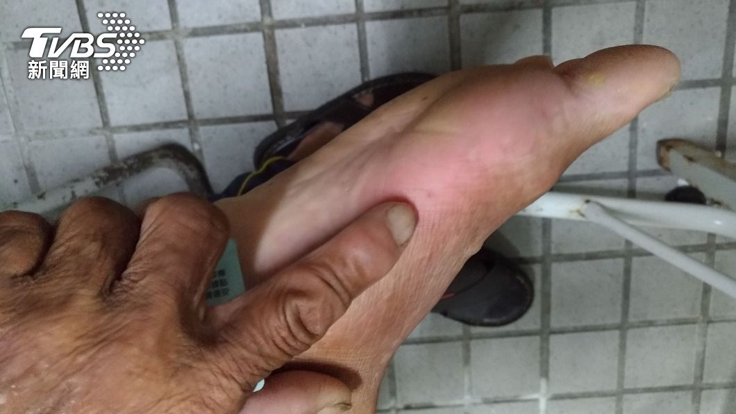 夏秋虎頭蜂超兇!台東老翁洗澡被螫 血壓飆高掛急診救命