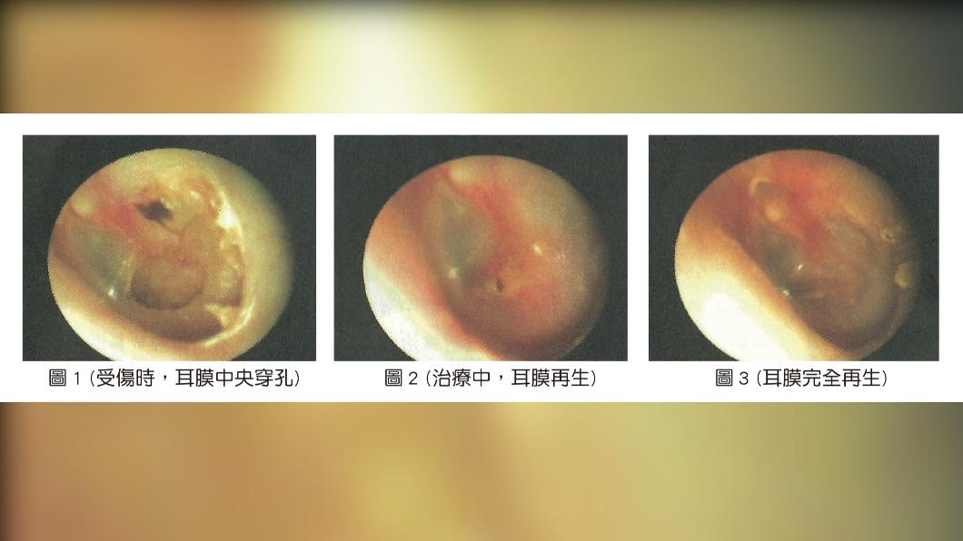 可使用顯微耳膜再生術讓耳膜再生。(圖/台北中山醫院)