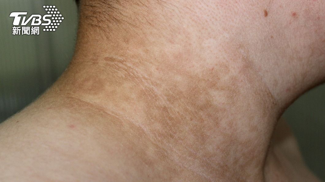 出代誌!女血糖飆400「脖子黑嚕嚕」 醫一問..傻了